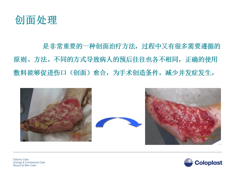 创面处理中敷料的使用.ppt_第2页