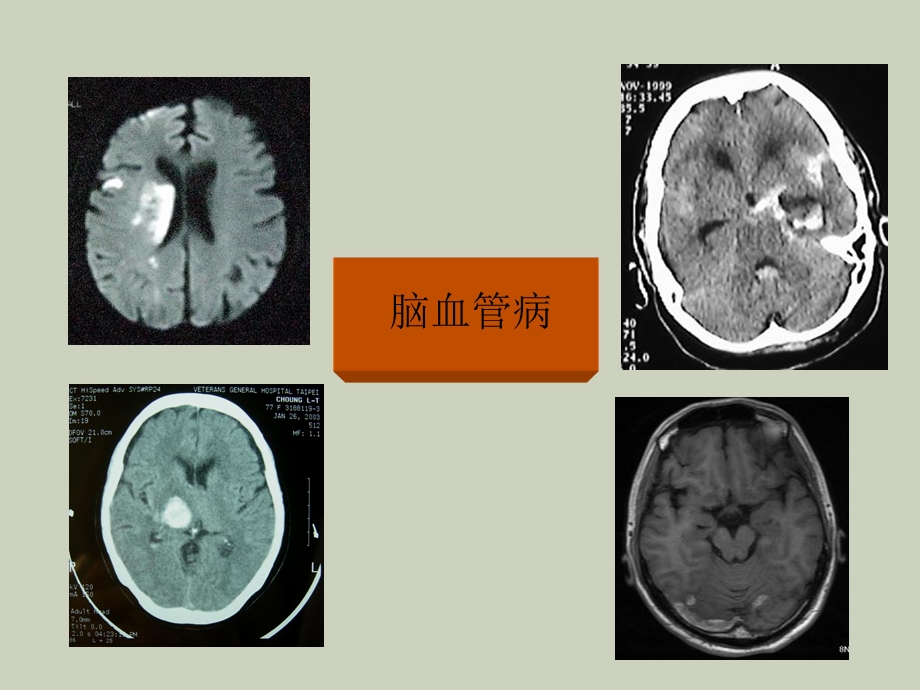 常见神经系统疾病诊治思路.ppt_第3页