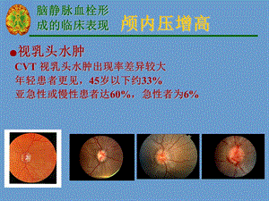 脑静脉血栓形.ppt