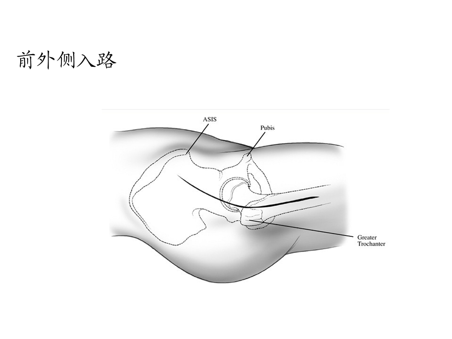 初次全髋关节置换手术技术要点.ppt_第3页