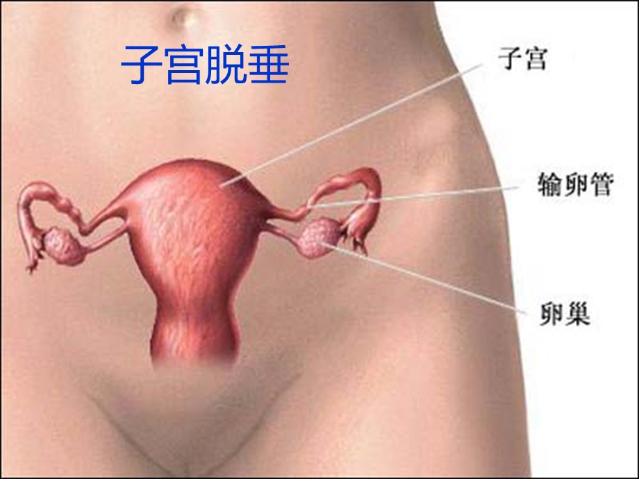 宫脱垂病人的护理.ppt_第1页