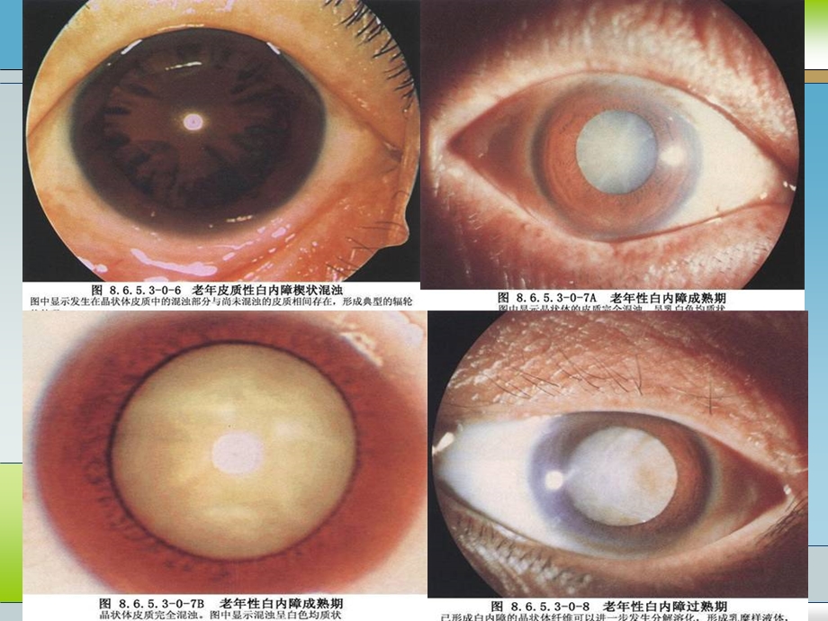 小切口白内障手术.ppt_第3页