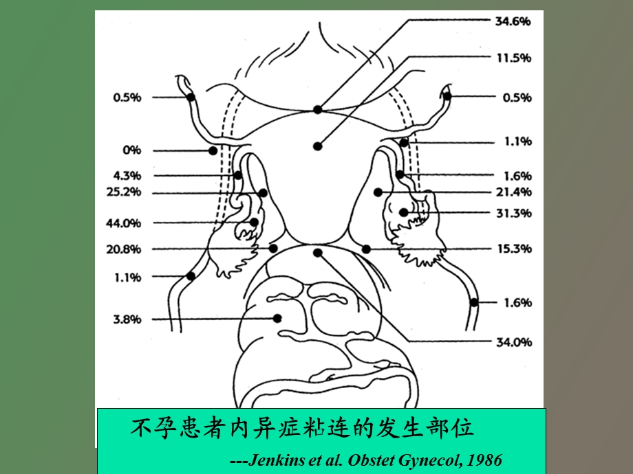 子宫内膜异位症与不育田秦杰.ppt_第3页