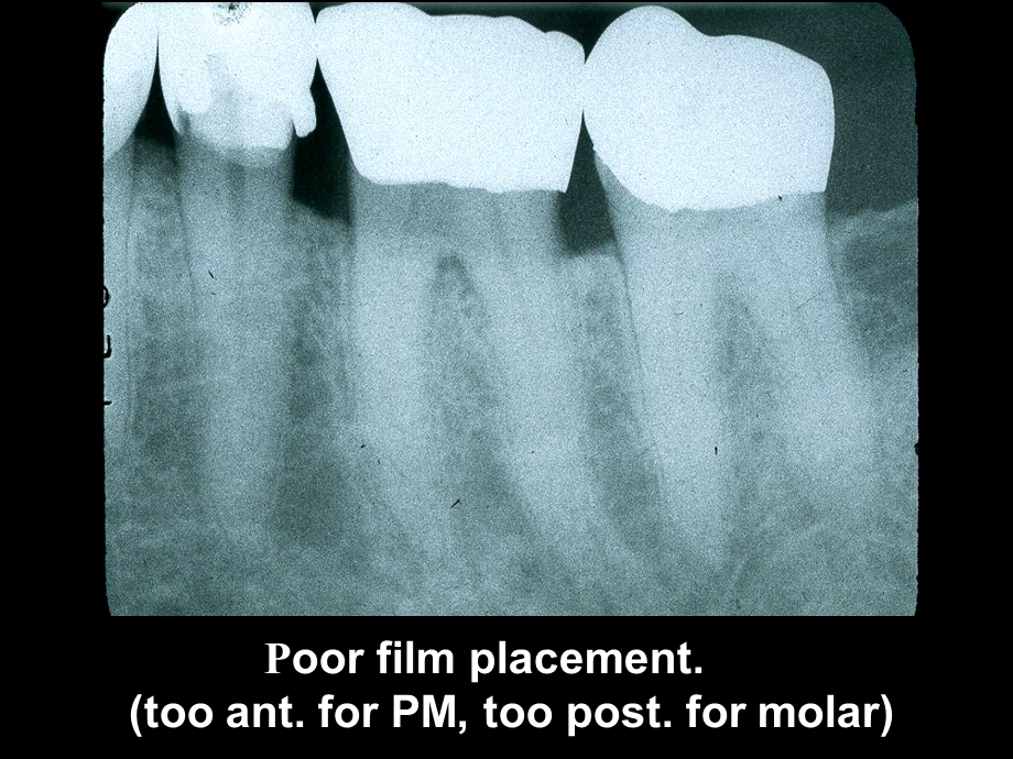 intraoral techerrors学会看拍牙片.ppt_第3页