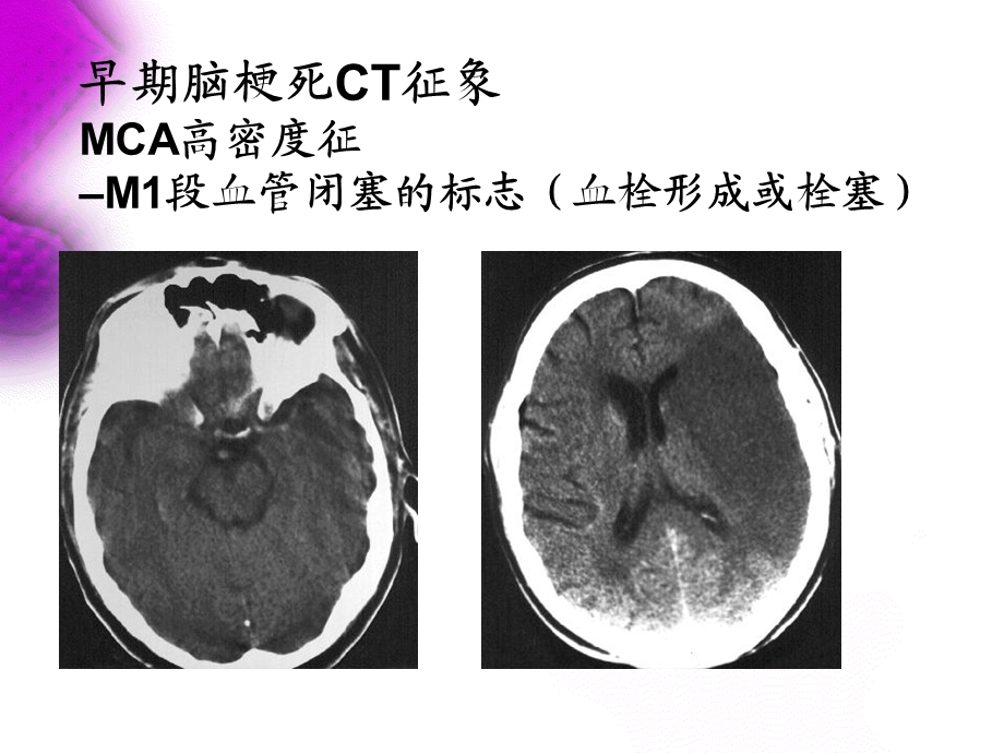 脑卒中综合征讲课课件.ppt_第3页