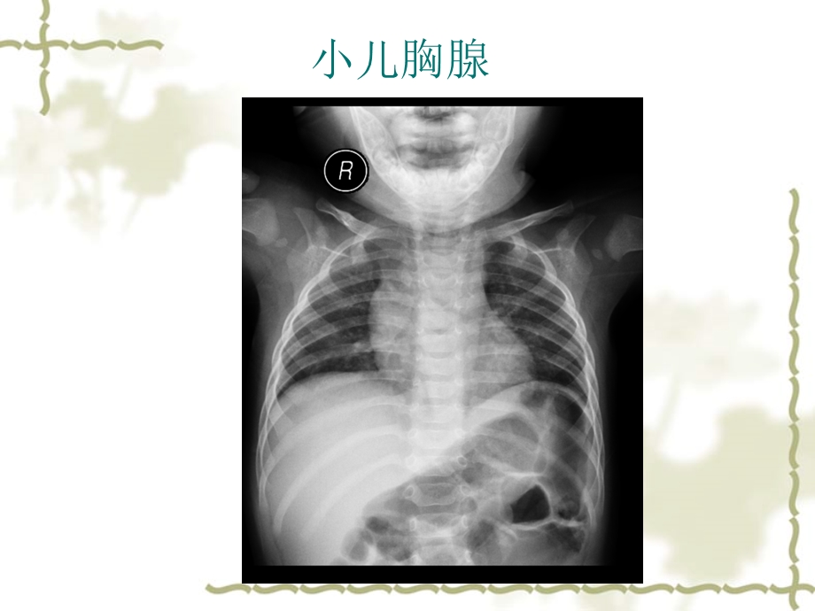 No.6.3.7学习指导 七年制影像chest 呼吸常见病1支气管病变肺炎肺结核 陈爱萍.ppt_第2页