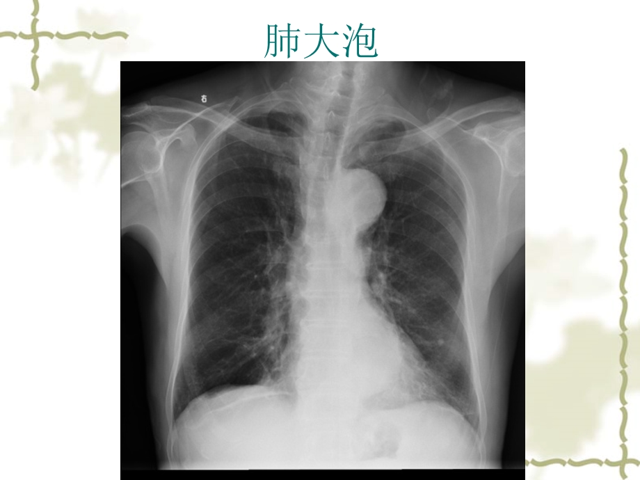 No.6.3.7学习指导 七年制影像chest 呼吸常见病1支气管病变肺炎肺结核 陈爱萍.ppt_第3页