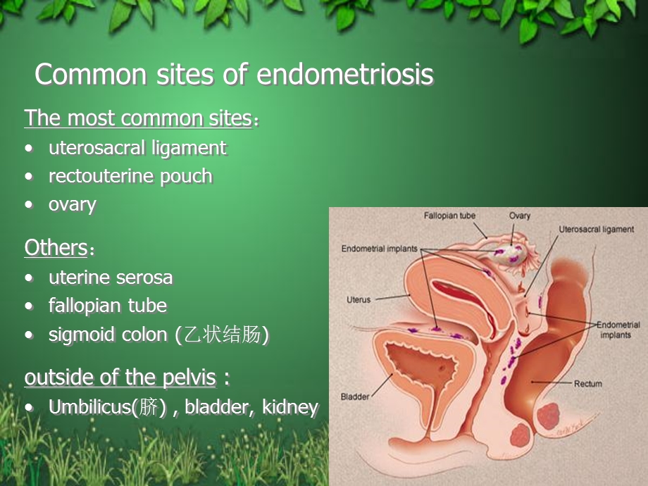 子宫内膜异位症Endometriosis-张喜.ppt_第3页