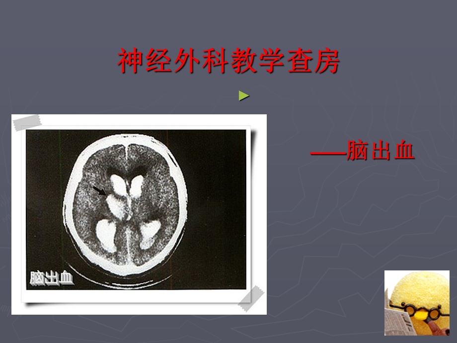 八月教学查房脑出血.ppt_第1页