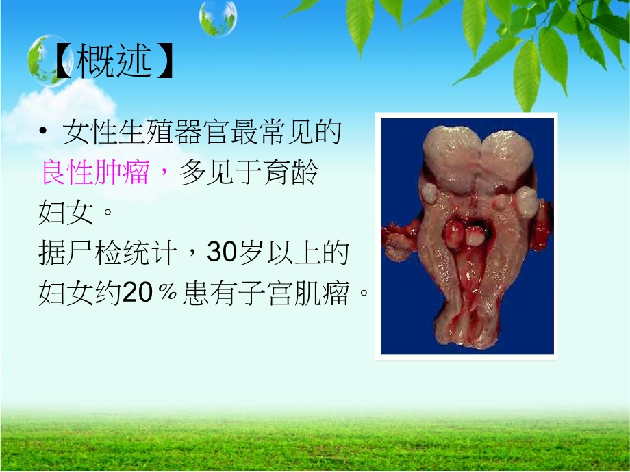 子宫肌瘤病人的术前术后护理.ppt_第3页