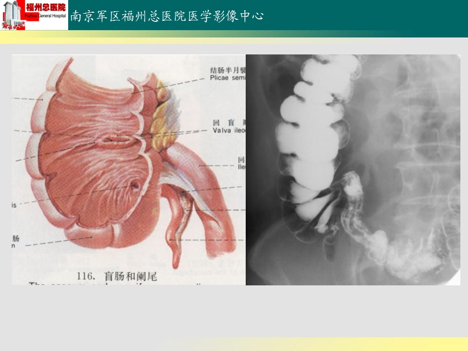 回盲部解剖特点及其病变的影像诊断.ppt_第3页