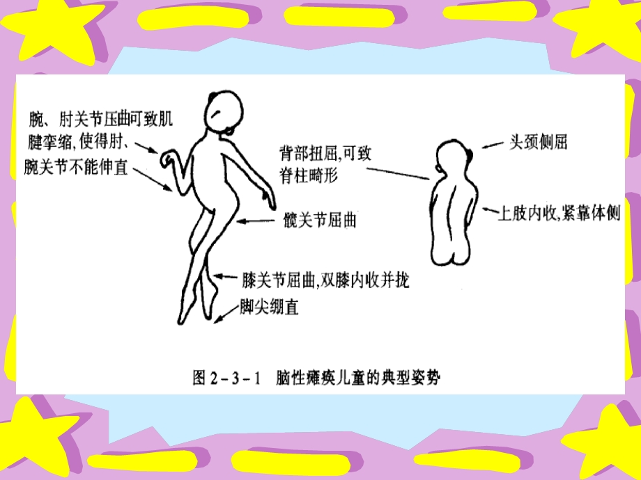 小儿脑瘫的康复中PT师的工作.ppt_第3页