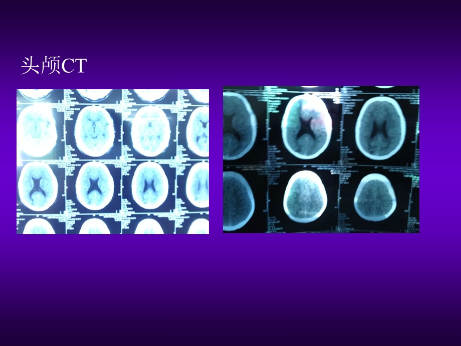 脑梗塞一例分享.ppt_第3页