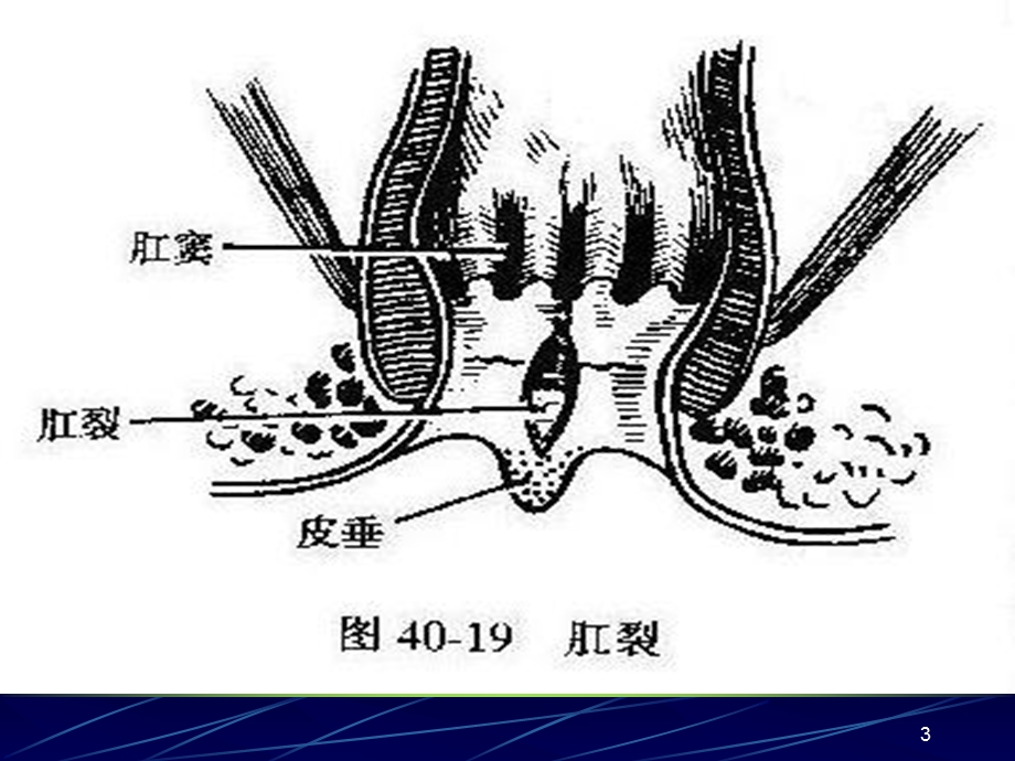 第四十一章结、直肠与肛管疾病.ppt_第3页