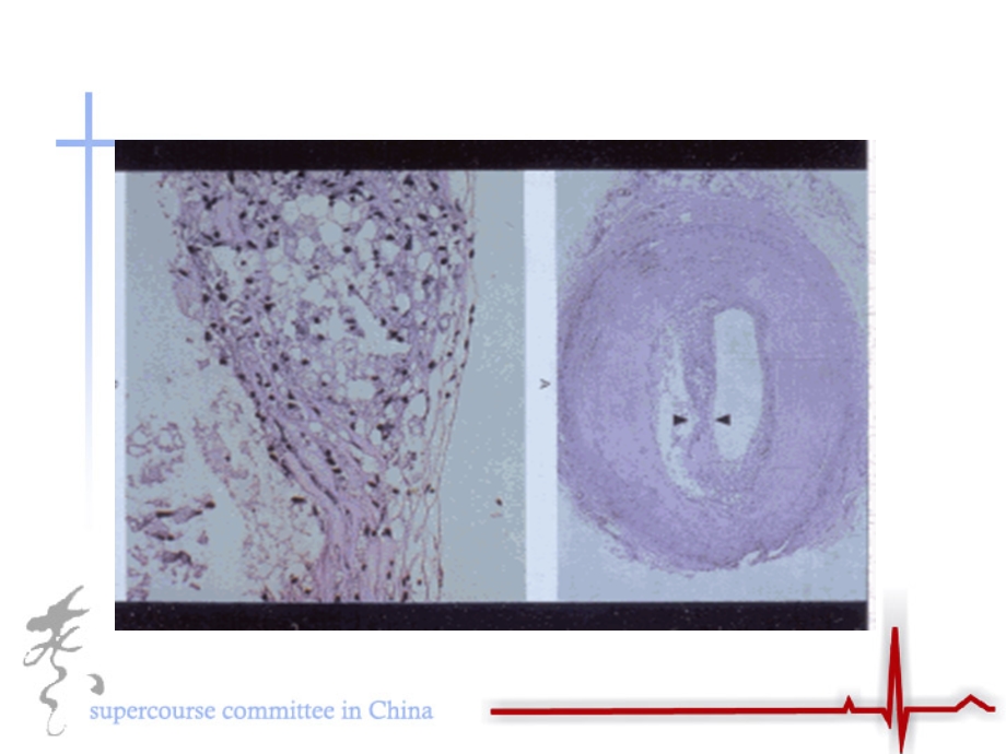 大脉管病炎症在糖尿病中作用.ppt_第3页