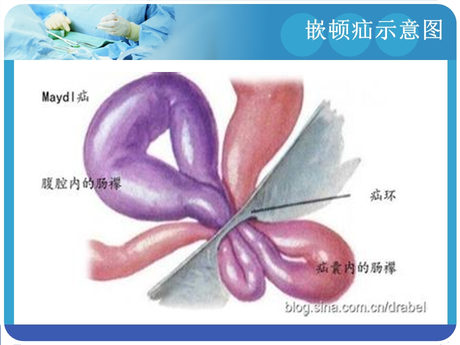 小儿嵌顿疝紧急处理.ppt_第3页