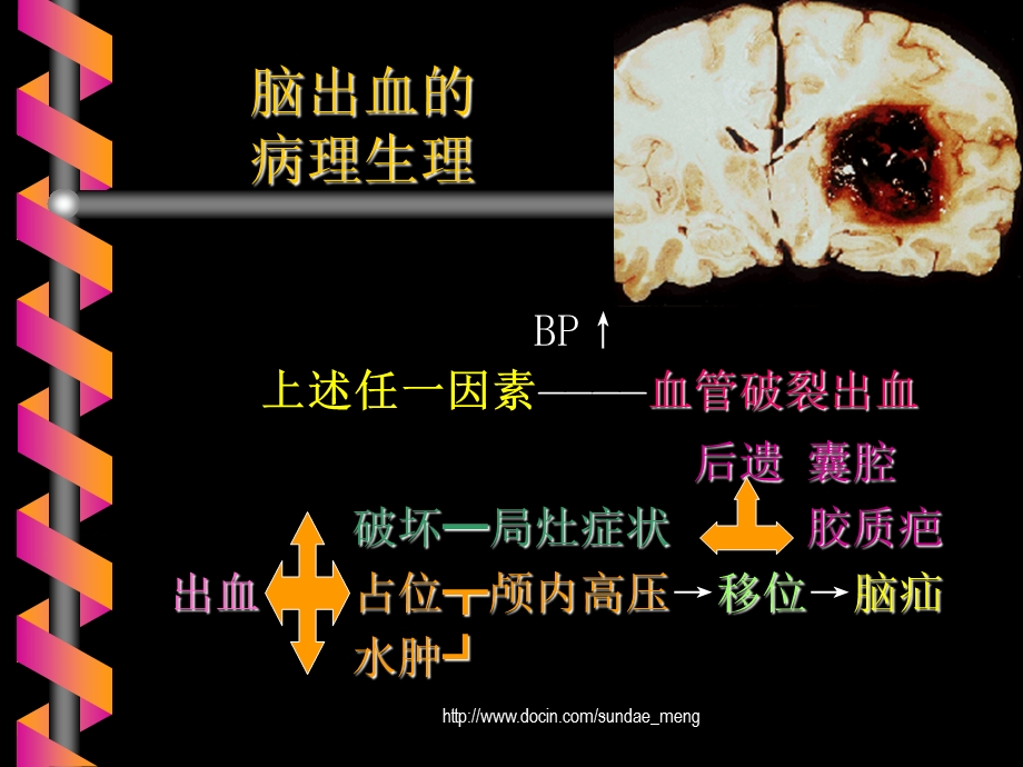 【大学课件】脑出血教案PPT.ppt_第2页