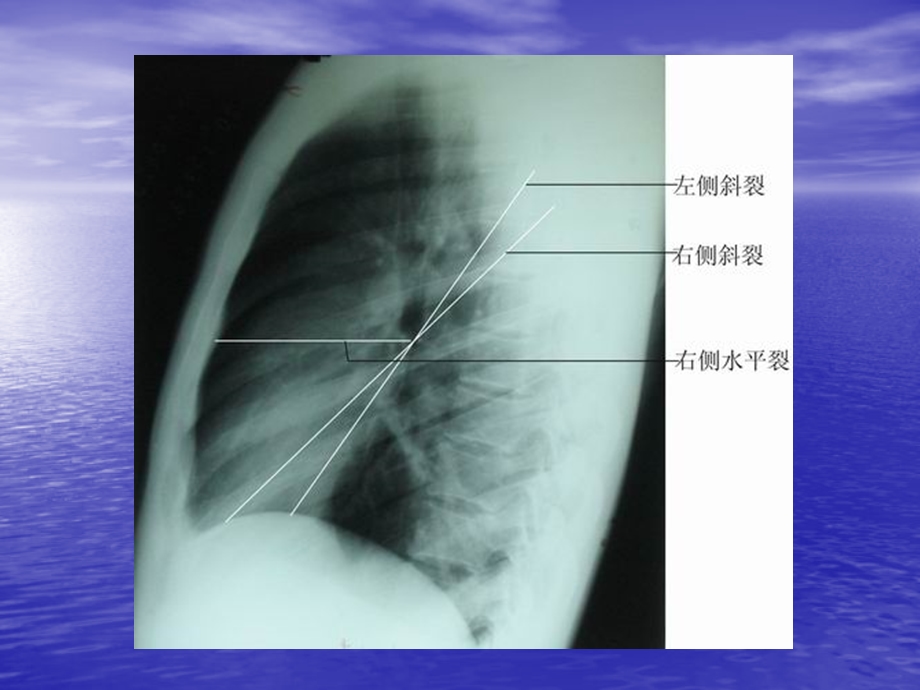 胸片上肺的分叶及右侧位片.ppt_第3页