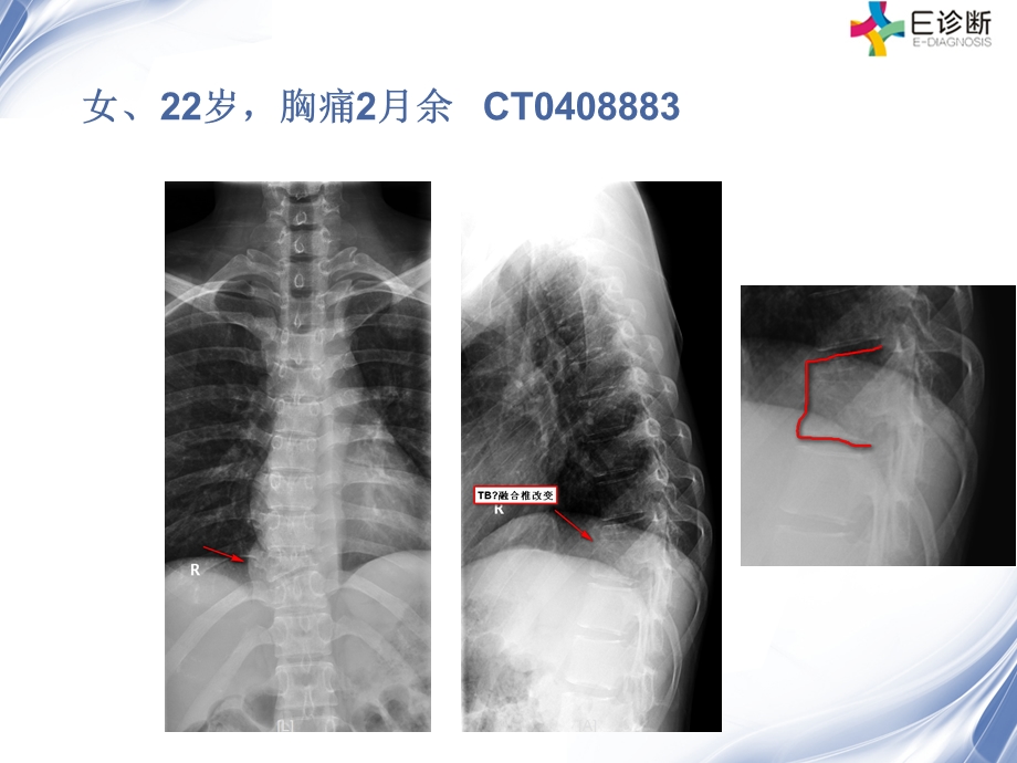 医学影像-脊柱原发性恶性淋巴瘤的影像诊断.ppt_第1页