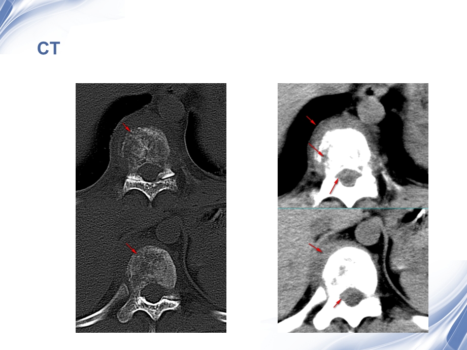 医学影像-脊柱原发性恶性淋巴瘤的影像诊断.ppt_第2页