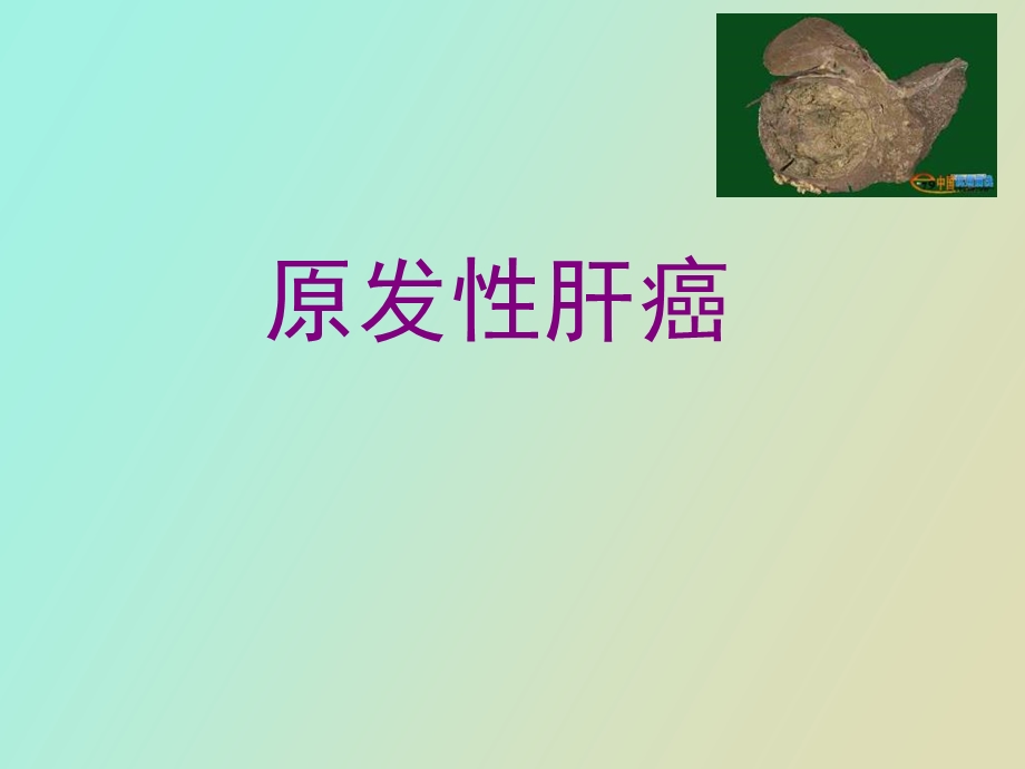 原发性肝癌本科班医学.ppt_第1页