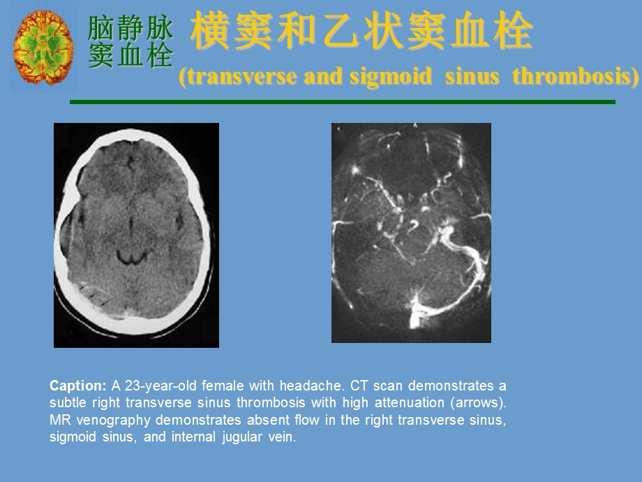 宣武颅内静脉系血栓.ppt_第3页