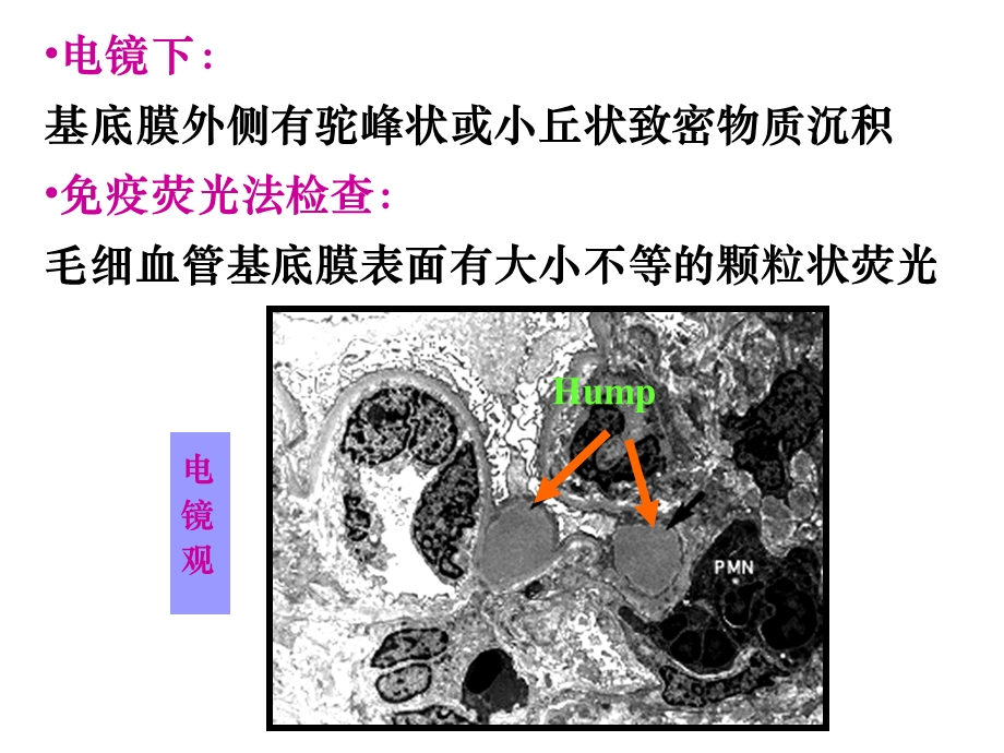 病理学肾小球肾炎(下部分).ppt_第1页