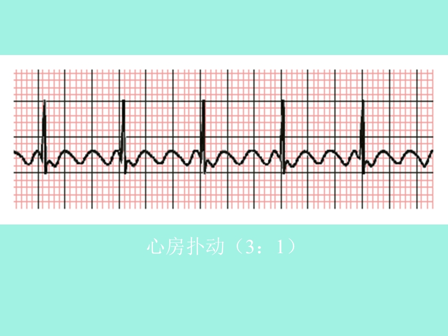 心律失常三扑动与颤动.ppt_第3页