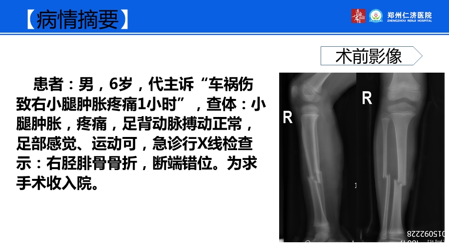 小儿胫骨骨折外固定治疗.ppt_第2页