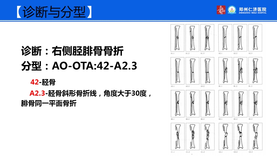 小儿胫骨骨折外固定治疗.ppt_第3页