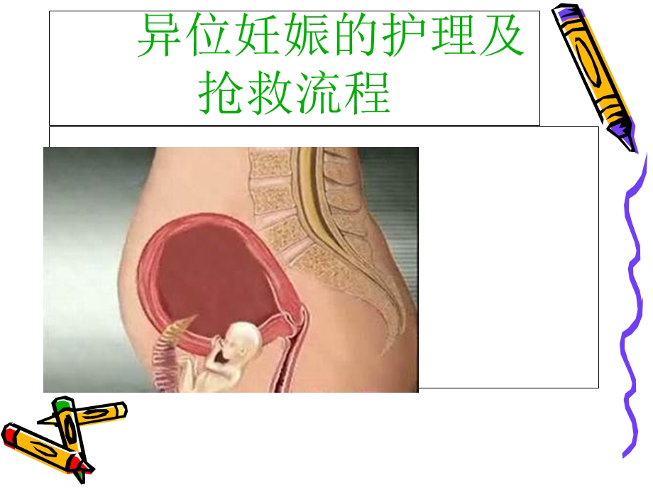 异位妊娠的护理及抢救流程.ppt_第1页