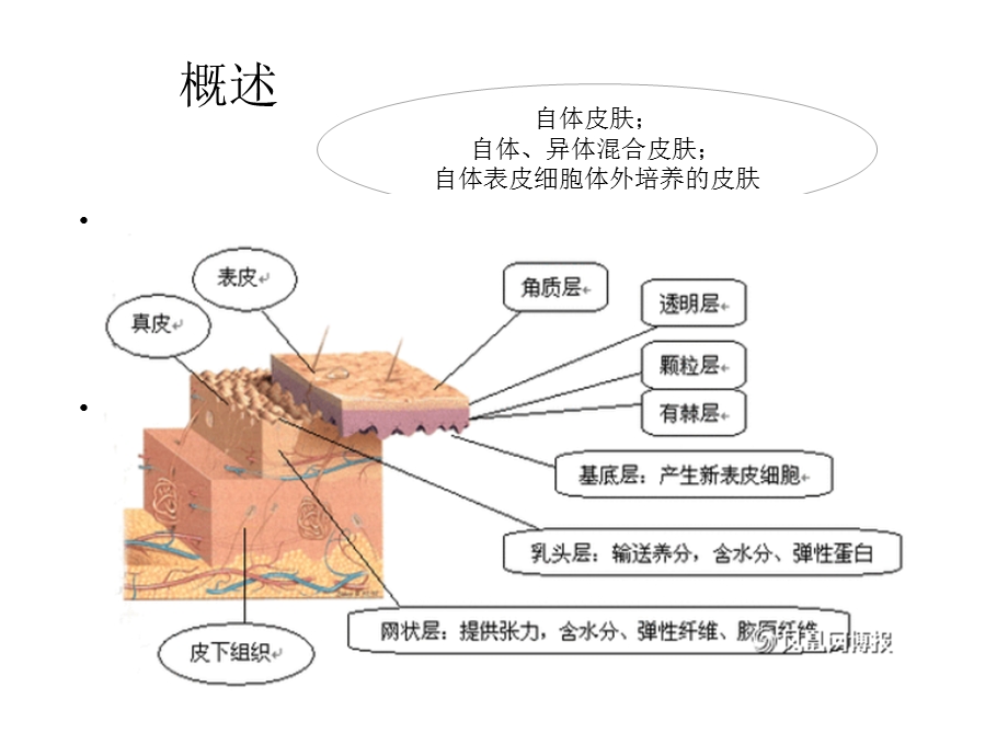 植皮病人的围手术期护理.ppt_第3页