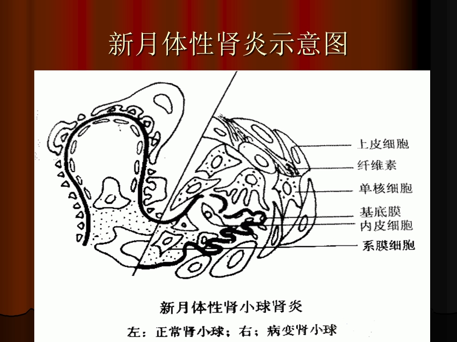 急进性肾小球肾炎.ppt_第3页