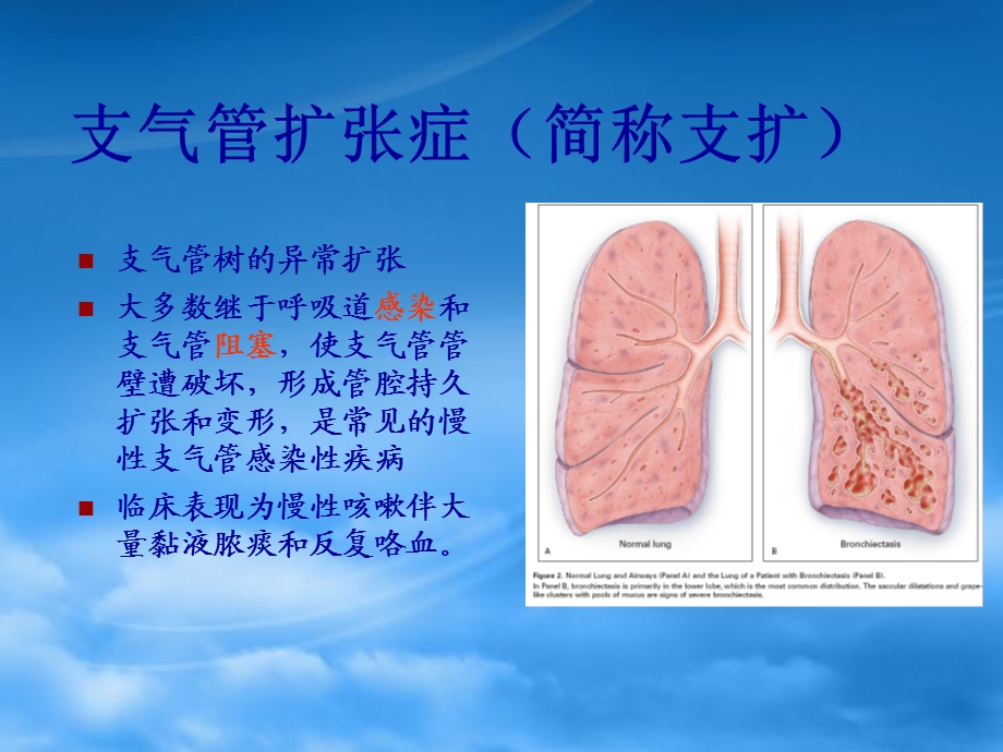 支气管扩张bronchiectasis.ppt_第2页