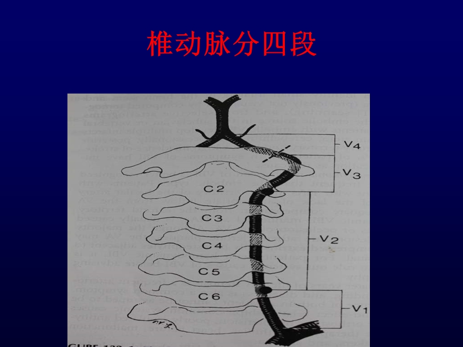 椎动脉病变的手术治疗.ppt_第3页