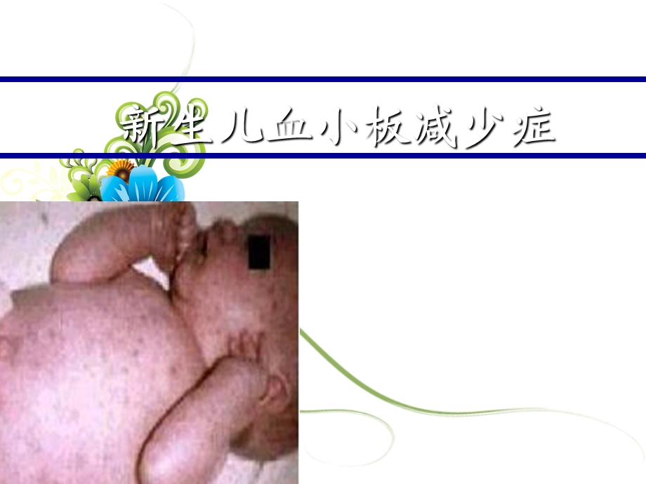 新生儿血小板减少症.ppt_第1页