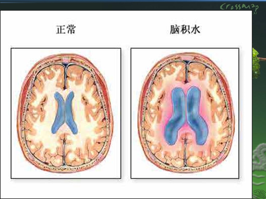 脑积水脑室腹腔分流术的护理.ppt_第3页