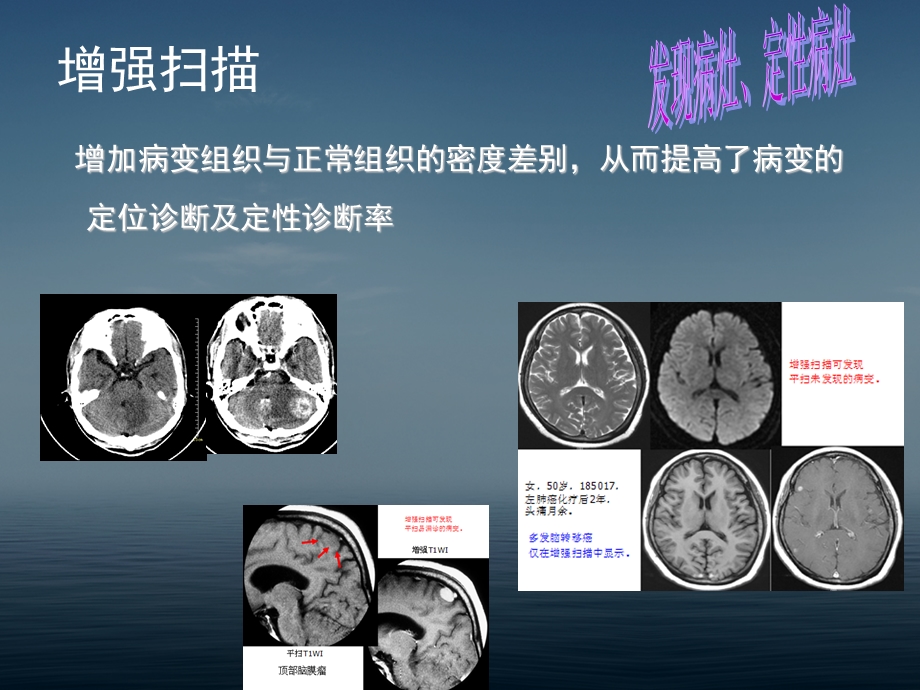 脑肿瘤CT和MR诊断 .ppt_第3页