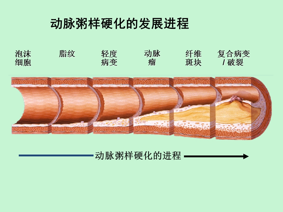 心肌梗死查房.ppt_第3页