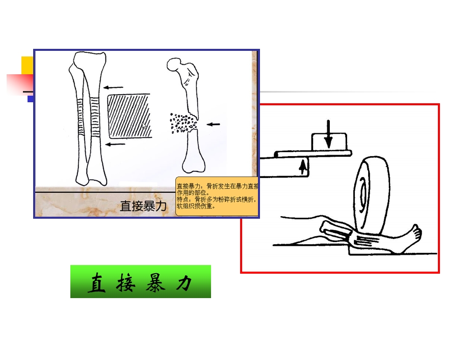 硕士学位班骨外专业辅导.ppt_第3页