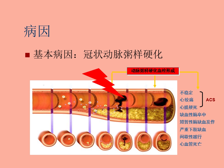 心梗疾病知识及护理.ppt_第3页