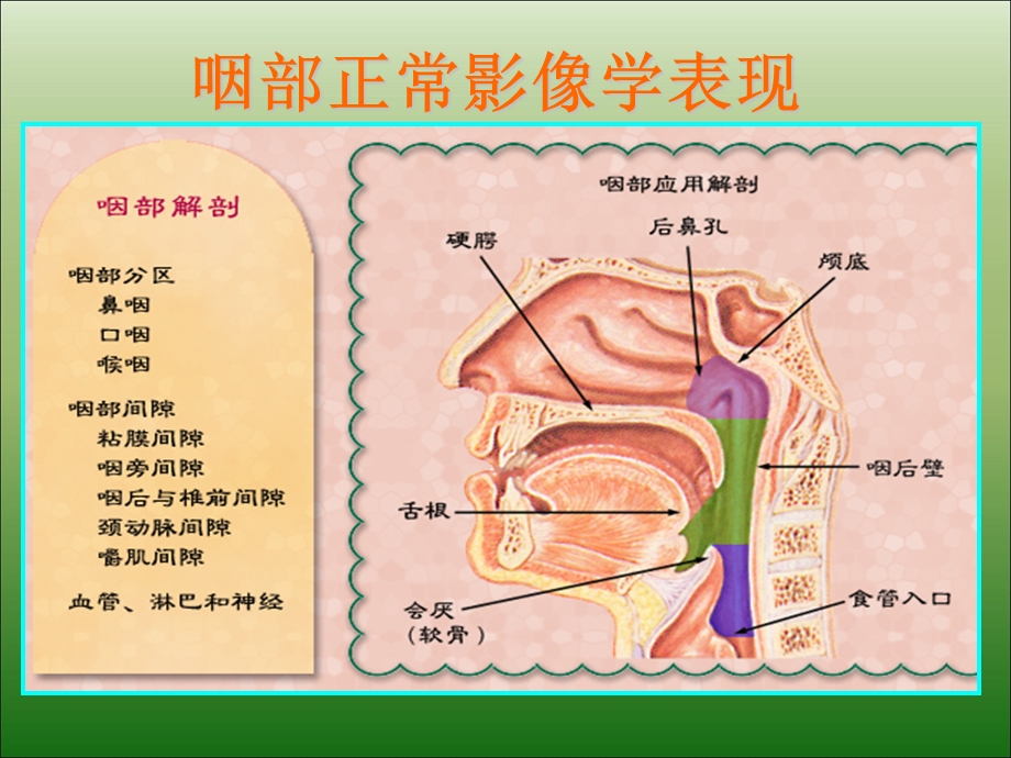 儿童腺样体肥大影像表现及诊断标准.ppt_第2页