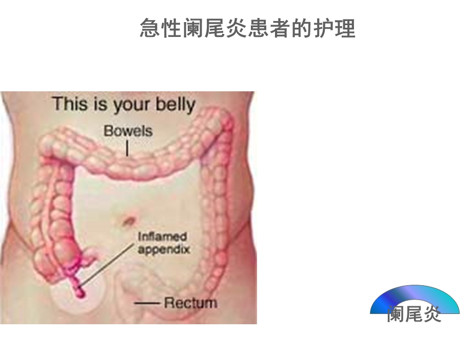 急性阑尾炎患者的护理PPT课件.ppt_第1页