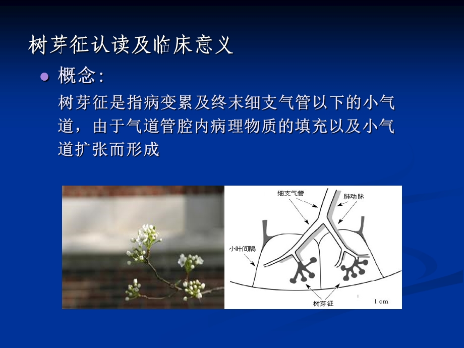 树芽征认读及临床意义.ppt_第2页