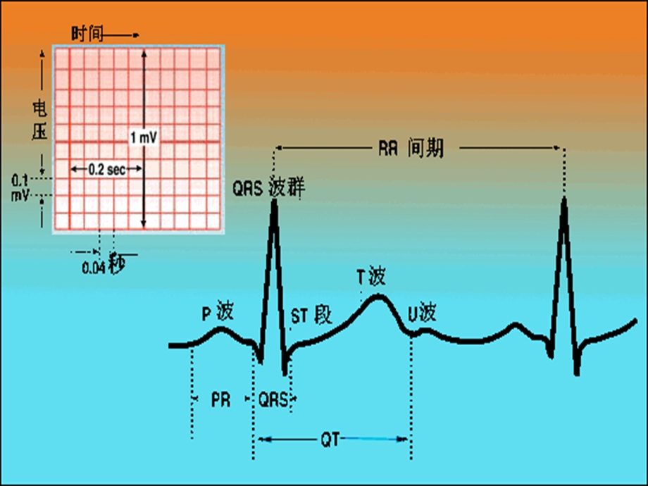 正常心电图及常见异常心电图的识别及处理.ppt_第3页