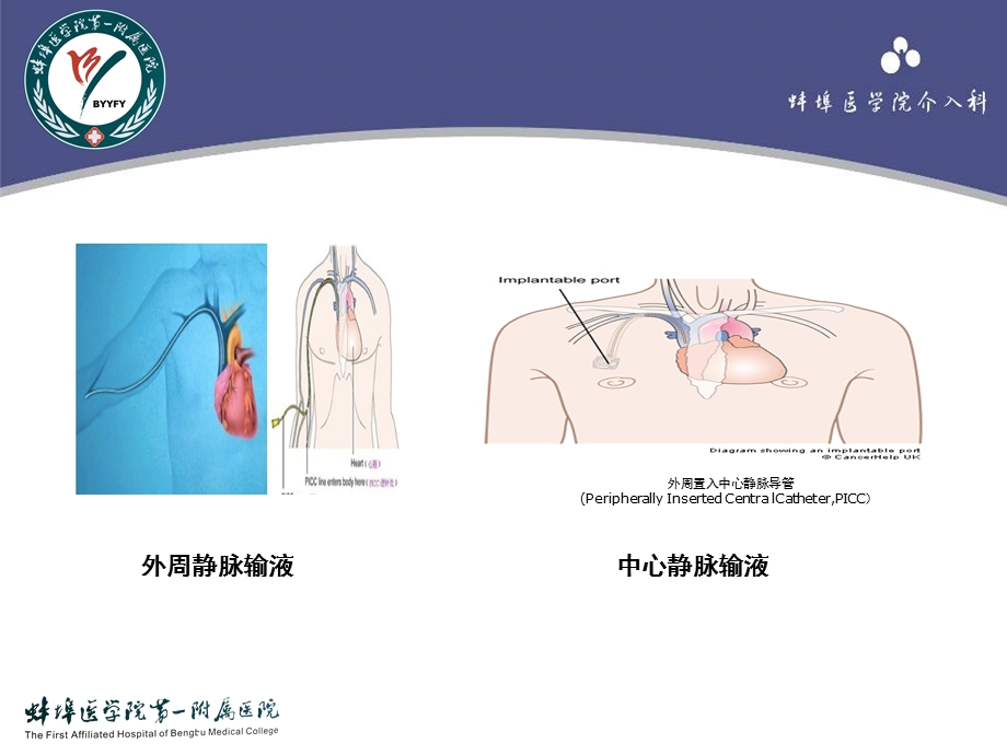 植入式输液港的应用谢波.ppt_第2页