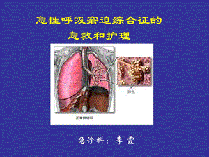 急性呼吸窘迫综合征的急救和护理.ppt