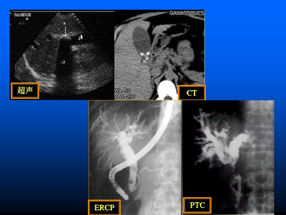 胆胰管疾病MRCP临床应用价值.ppt_第3页