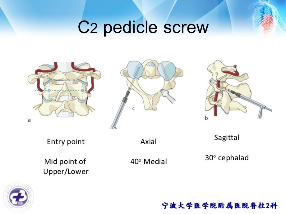 椎动脉高跨和颈2椎板螺钉.ppt_第2页