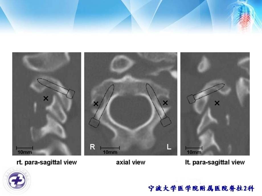 椎动脉高跨和颈2椎板螺钉.ppt_第3页